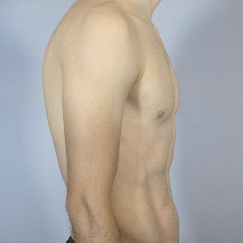 Abdominal Etching Before & After Gallery - Patient 199729 - Image 6