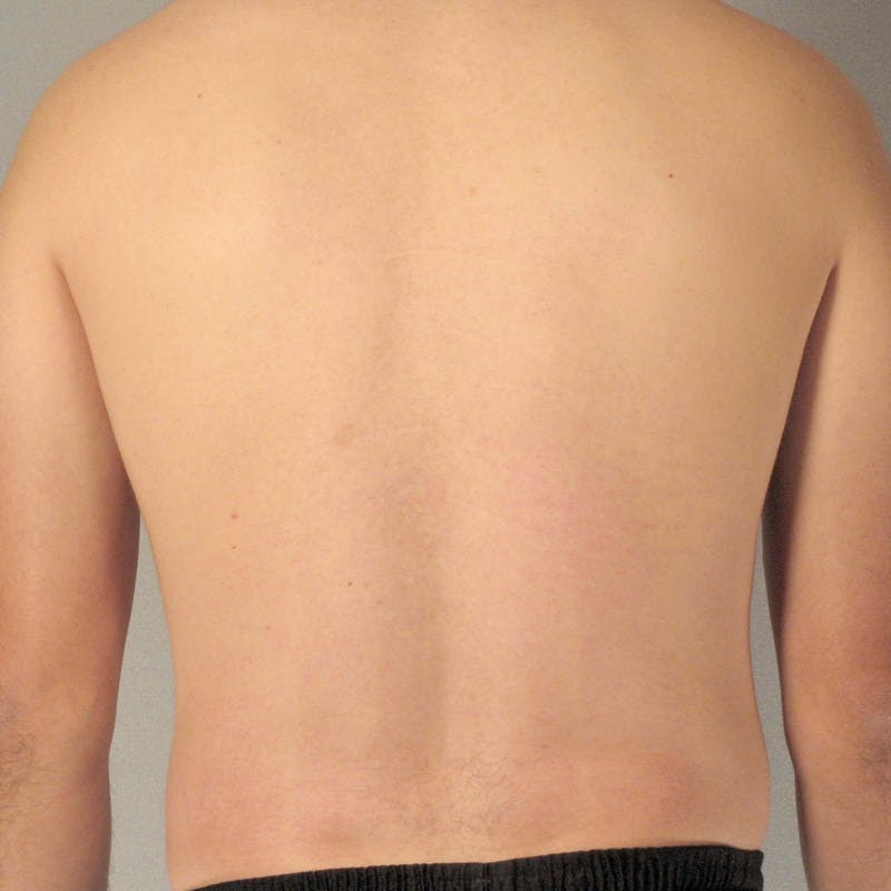 Abdominal Etching Before & After Gallery - Patient 199729 - Image 7