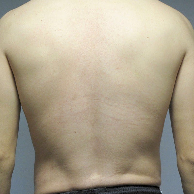Abdominal Etching Before & After Gallery - Patient 199729 - Image 8