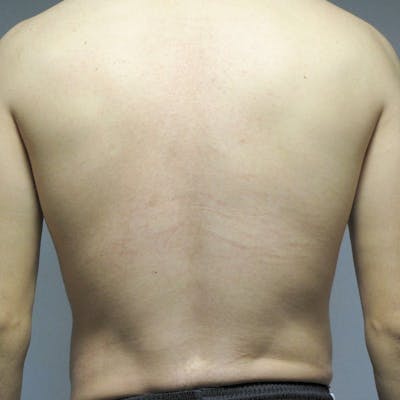 Abdominal Etching Before & After Gallery - Patient 199729 - Image 8