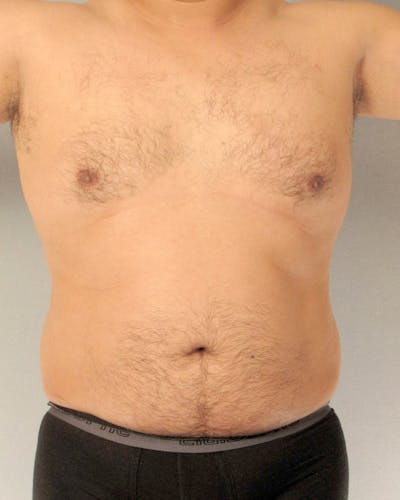 Abdominal Etching Before & After Gallery - Patient 602308 - Image 1