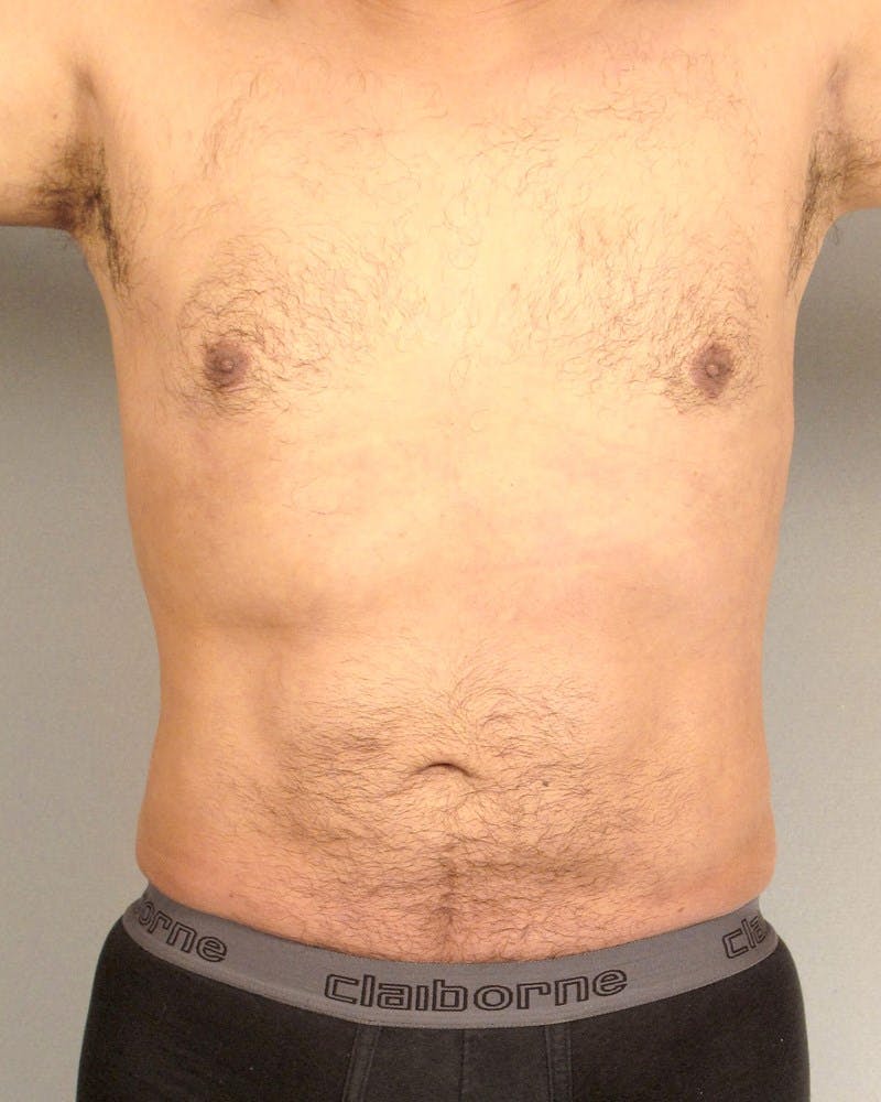 Abdominal Etching Before & After Gallery - Patient 602308 - Image 2