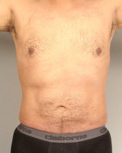 Abdominal Etching Before & After Gallery - Patient 602308 - Image 2