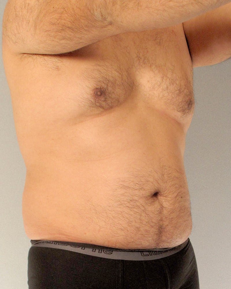 Abdominal Etching Before & After Gallery - Patient 602308 - Image 3