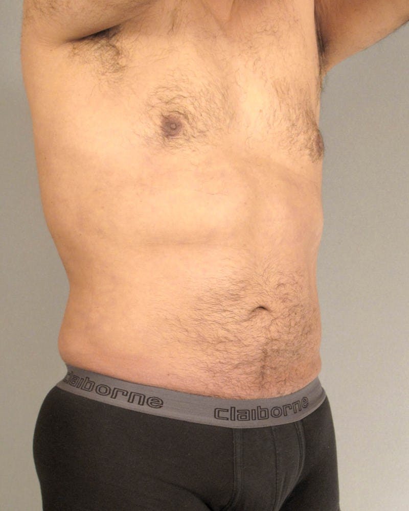 Abdominal Etching Before & After Gallery - Patient 602308 - Image 4