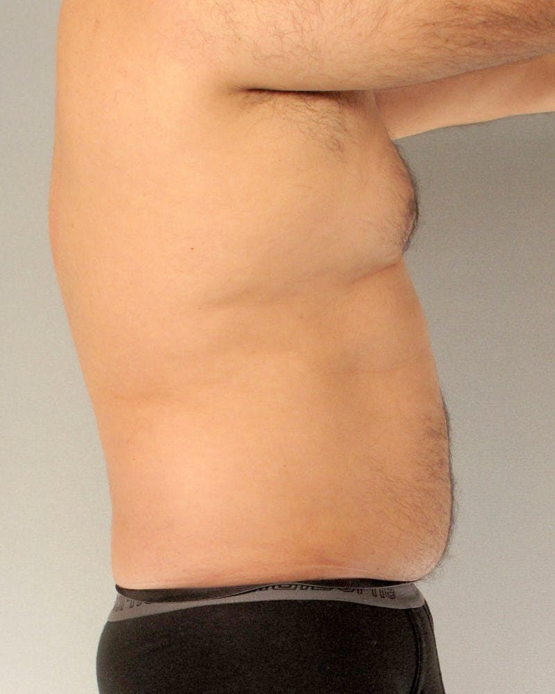 Abdominal Etching Before & After Gallery - Patient 602308 - Image 5