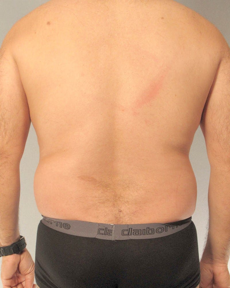 Abdominal Etching Before & After Gallery - Patient 602308 - Image 7