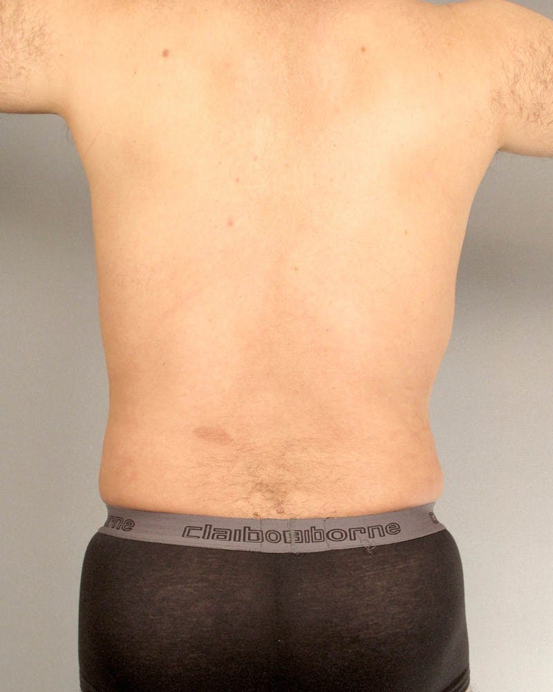 Abdominal Etching Before & After Gallery - Patient 602308 - Image 8