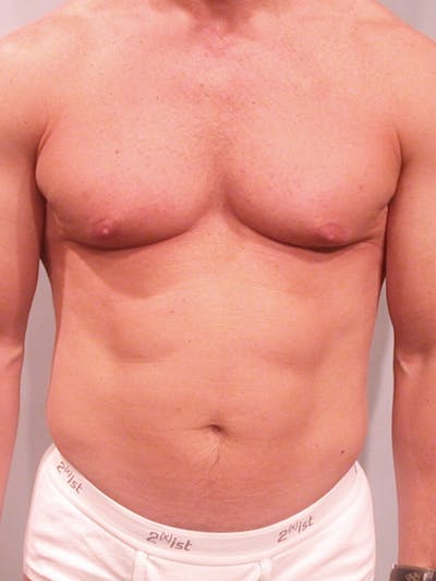 Abdominal Etching Before & After Gallery - Patient 202915 - Image 1