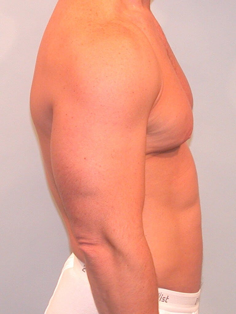 Abdominal Etching Before & After Gallery - Patient 202915 - Image 5