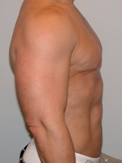 Abdominal Etching Before & After Gallery - Patient 202915 - Image 6