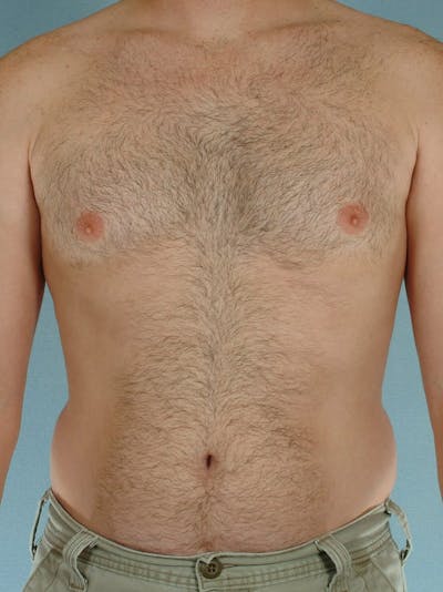 Abdominal Etching Before & After Gallery - Patient 414690 - Image 1