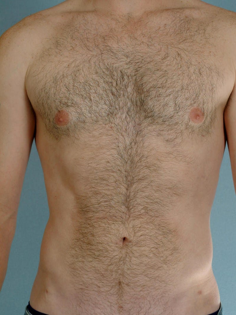 Abdominal Etching Before & After Gallery - Patient 414690 - Image 2