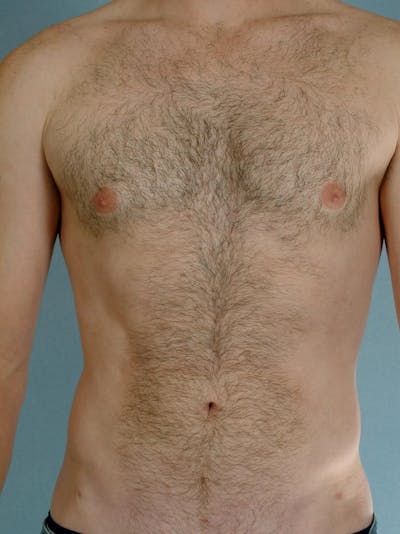 Abdominal Etching Before & After Gallery - Patient 414690 - Image 2