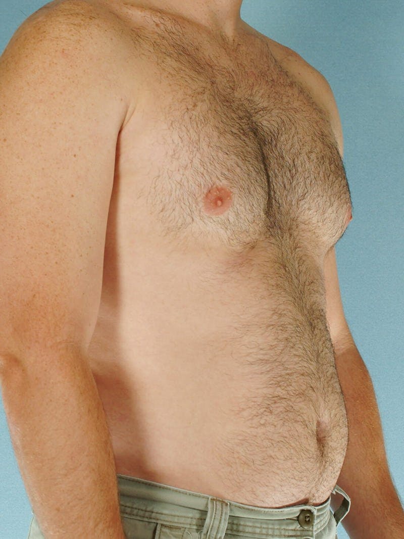 Abdominal Etching Before & After Gallery - Patient 414690 - Image 3