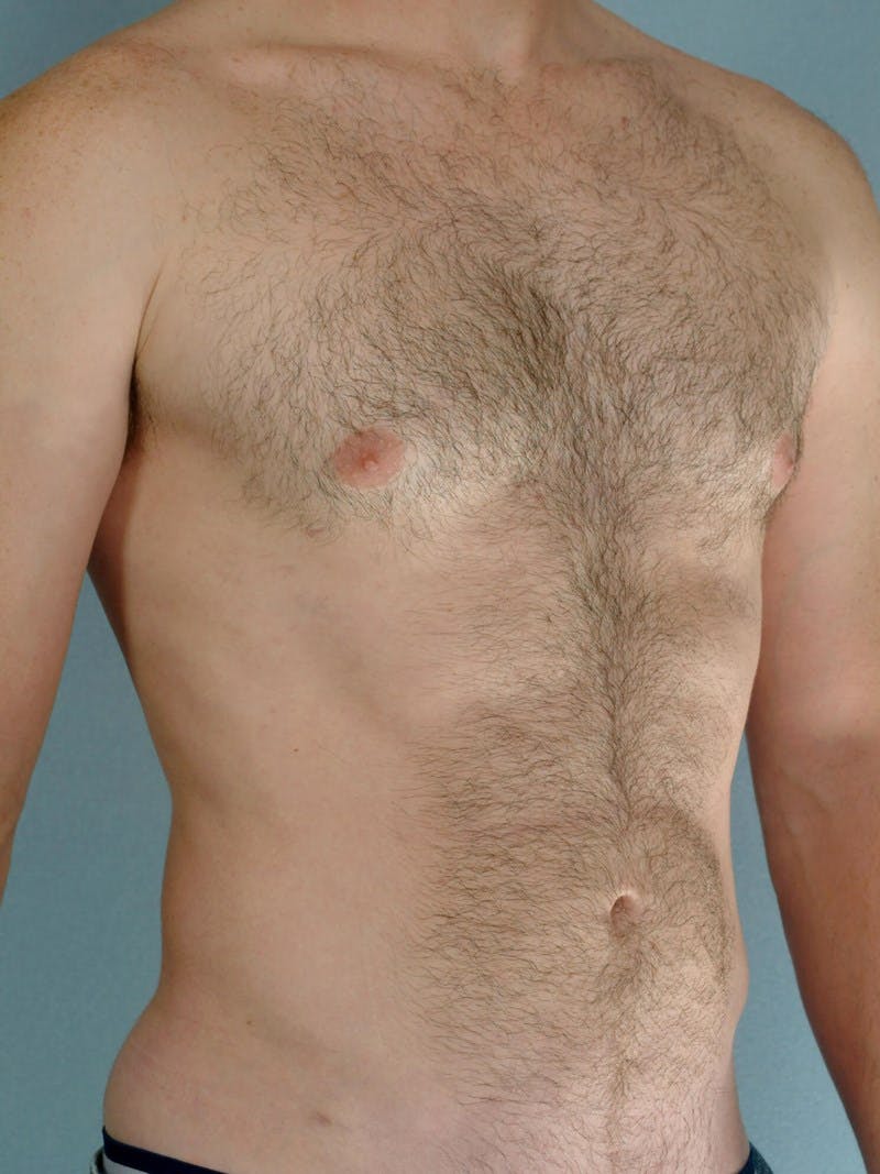 Abdominal Etching Before & After Gallery - Patient 414690 - Image 4