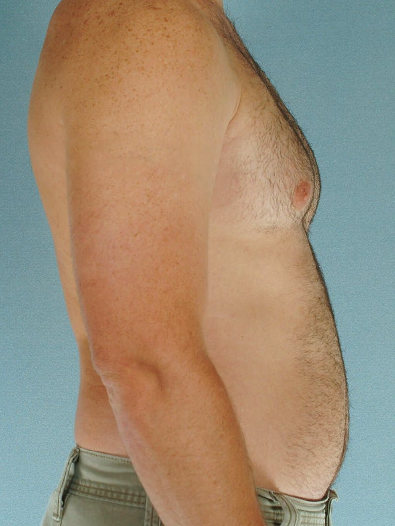Abdominal Etching Before & After Gallery - Patient 414690 - Image 5