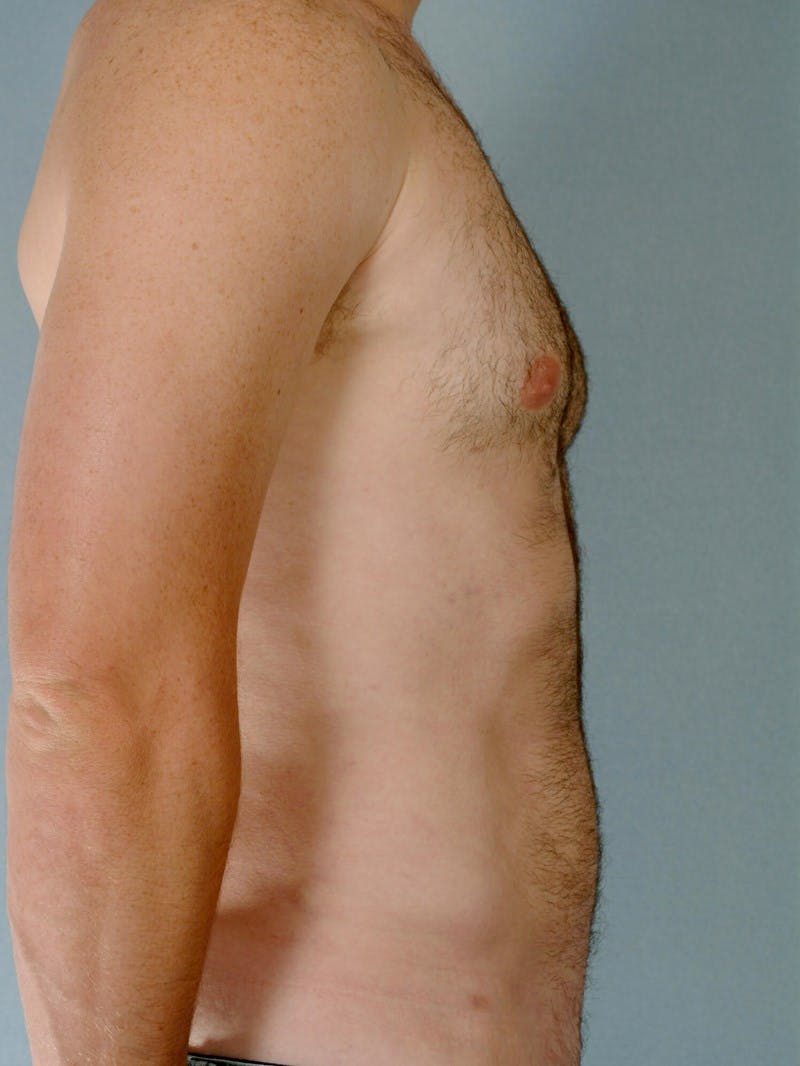 Abdominal Etching Before & After Gallery - Patient 414690 - Image 6