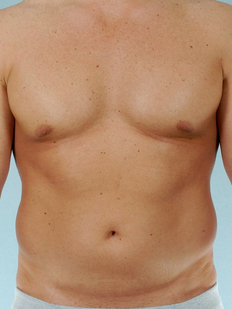 Abdominal Etching Before & After Gallery - Patient 105758 - Image 1