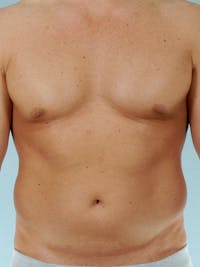 Abdominal Etching Before & After Gallery - Patient 105758 - Image 1