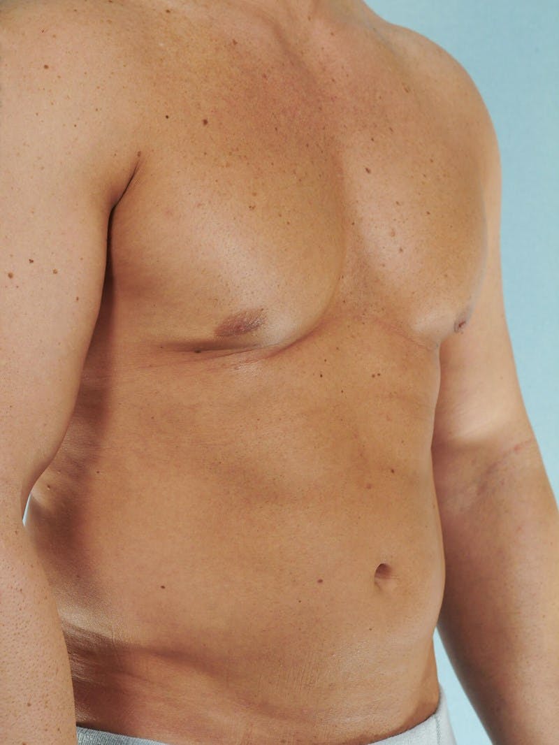 Abdominal Etching Before & After Gallery - Patient 105758 - Image 3