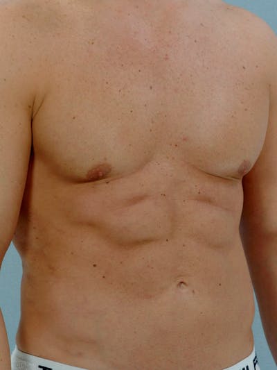 Abdominal Etching Before & After Gallery - Patient 105758 - Image 4