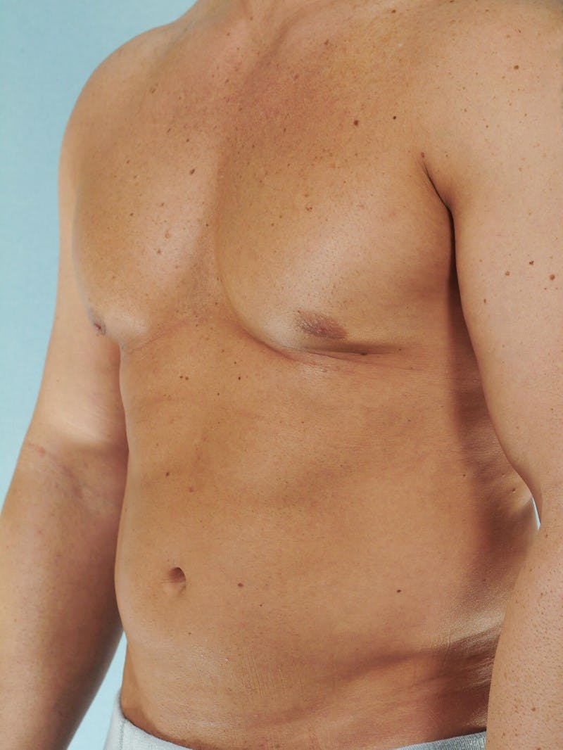 Abdominal Etching Before & After Gallery - Patient 105758 - Image 5