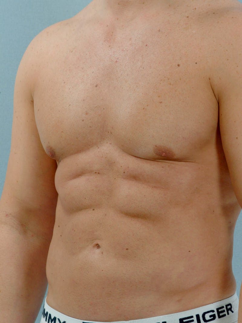 Abdominal Etching Before & After Gallery - Patient 105758 - Image 6