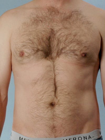 Abdominal Etching Before & After Gallery - Patient 249115 - Image 1