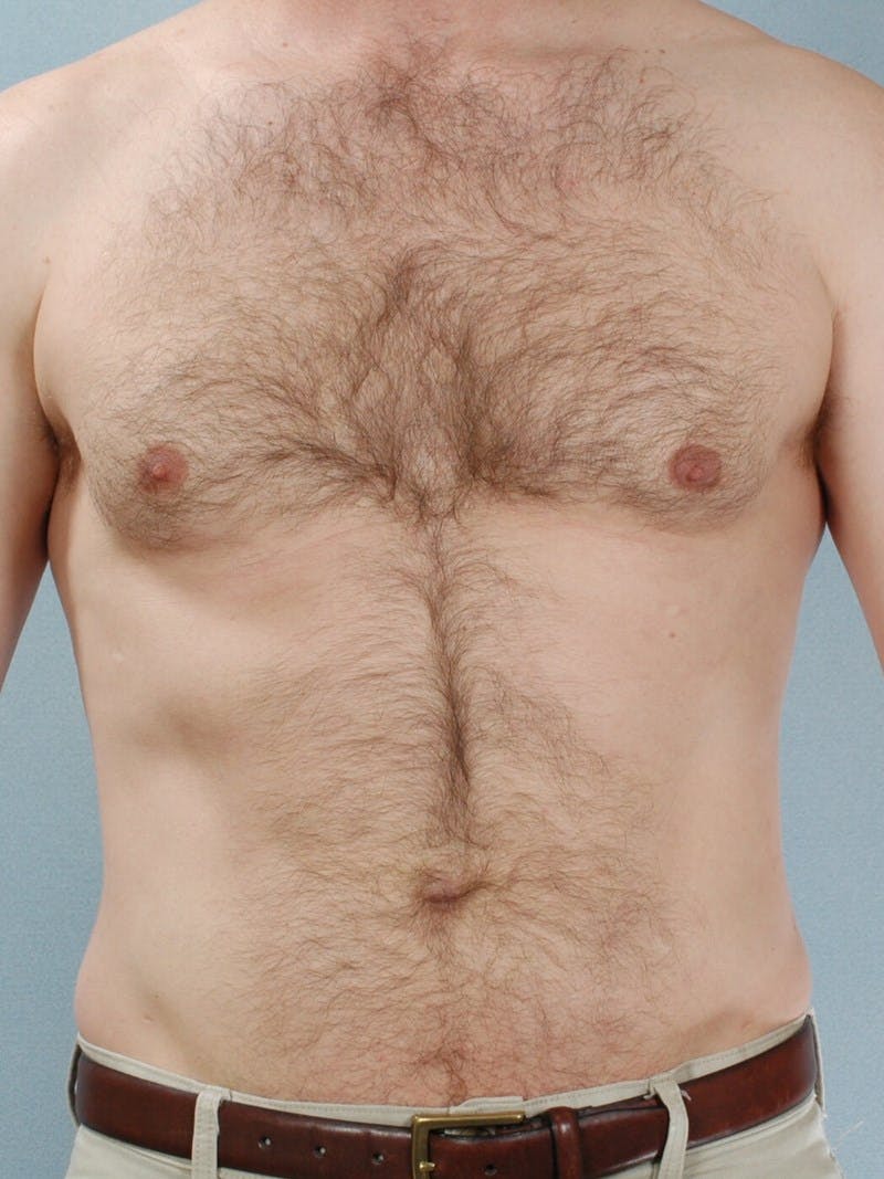 Abdominal Etching Before & After Gallery - Patient 249115 - Image 2