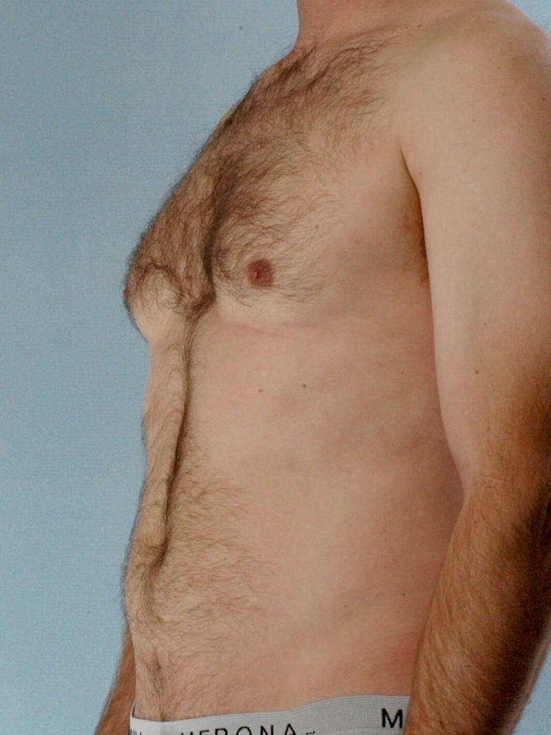 Abdominal Etching Before & After Gallery - Patient 249115 - Image 3
