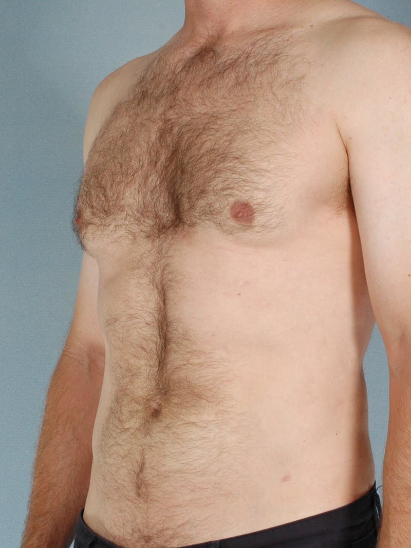 Abdominal Etching Before & After Gallery - Patient 249115 - Image 4