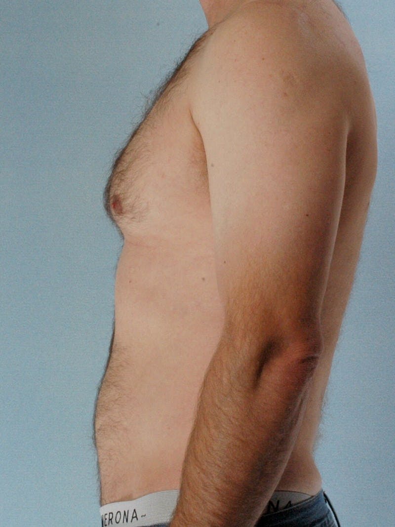 Abdominal Etching Before & After Gallery - Patient 249115 - Image 5
