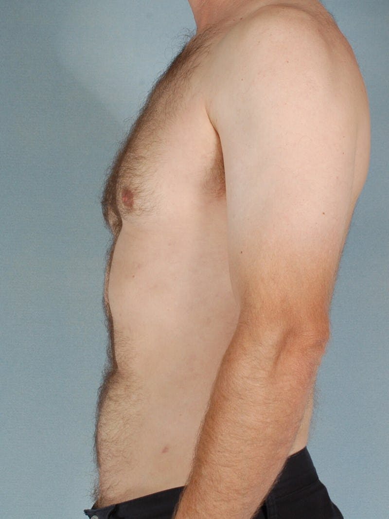 Abdominal Etching Before & After Gallery - Patient 249115 - Image 6