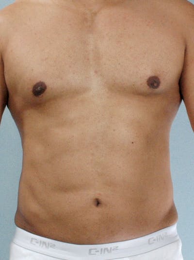 Abdominal Etching Before & After Gallery - Patient 412103 - Image 2