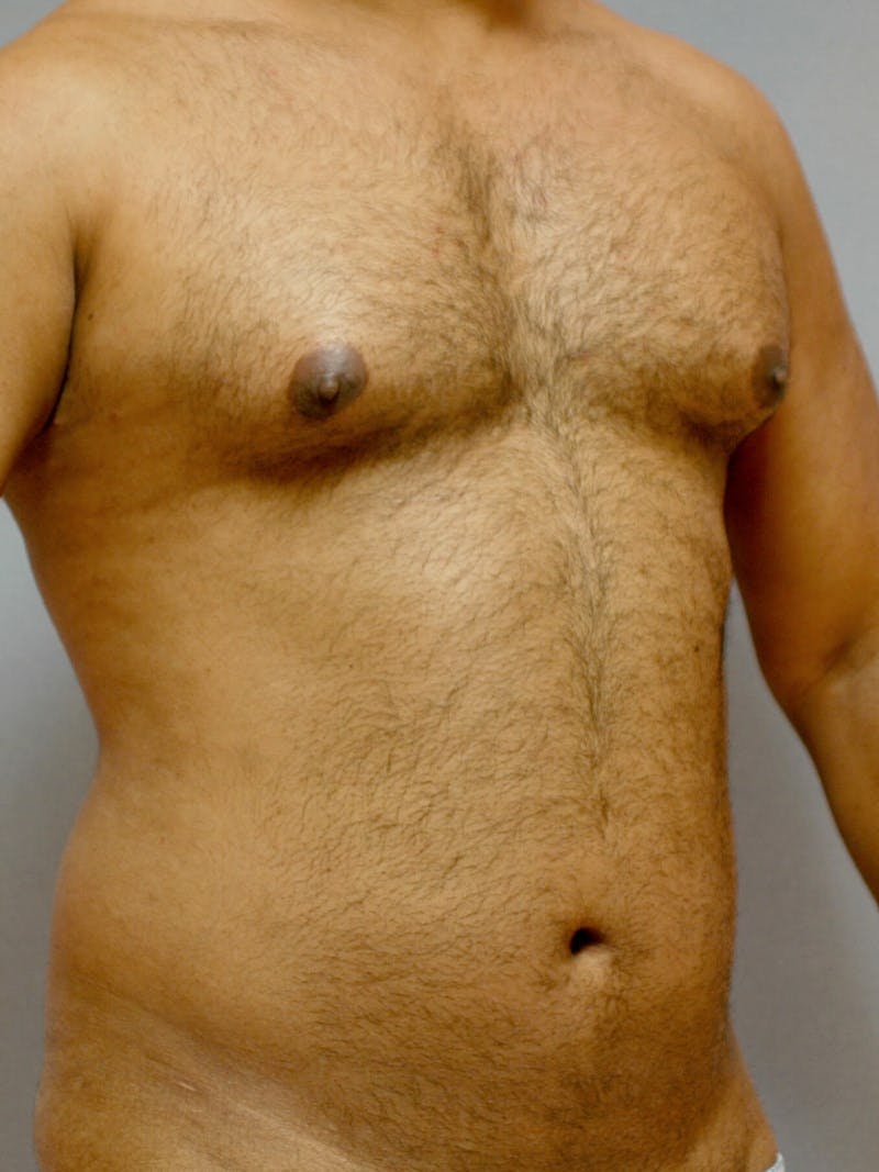 Abdominal Etching Before & After Gallery - Patient 412103 - Image 3