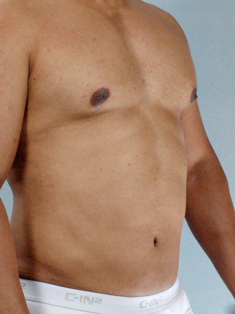 Abdominal Etching Before & After Gallery - Patient 412103 - Image 4