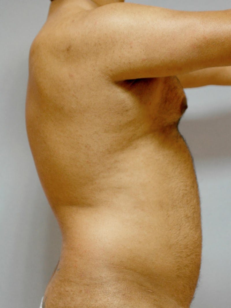 Abdominal Etching Before & After Gallery - Patient 412103 - Image 5