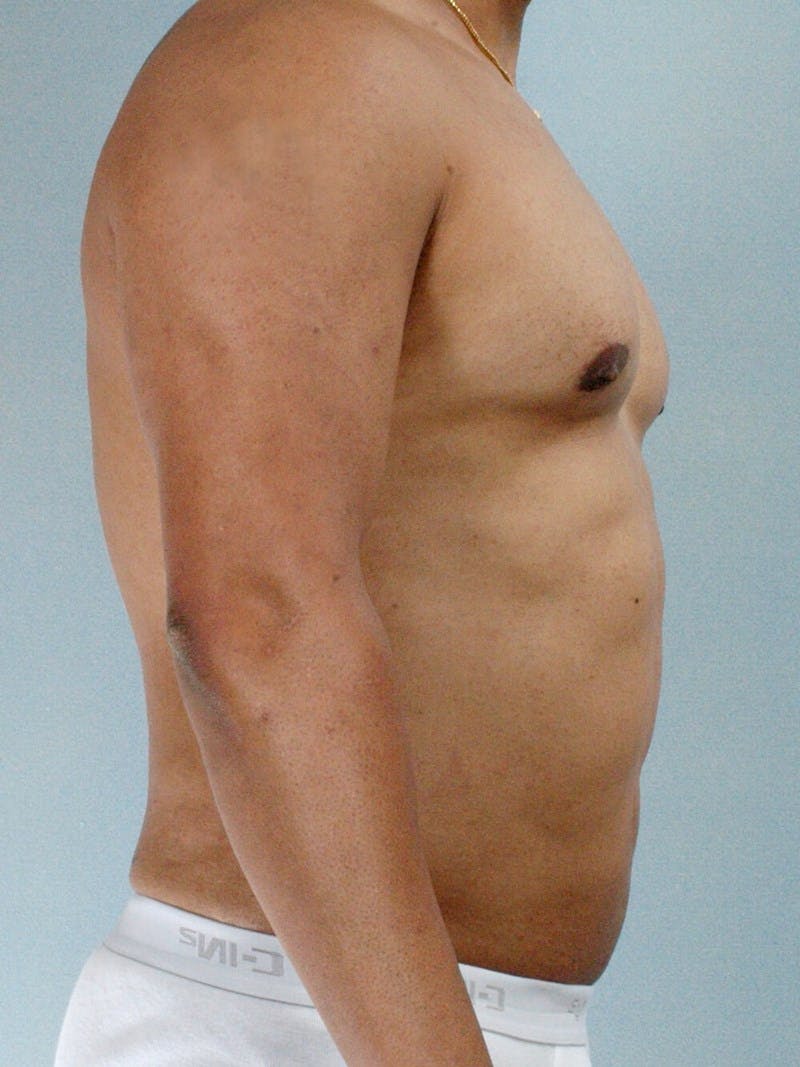 Abdominal Etching Before & After Gallery - Patient 412103 - Image 6