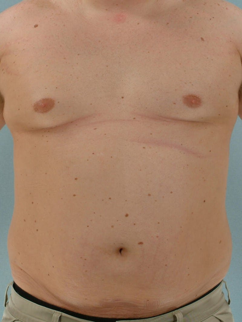 Abdominal Etching Before & After Gallery - Patient 191950 - Image 1