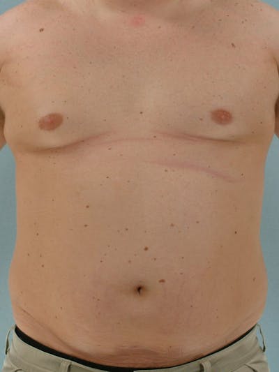 Abdominal Etching Before & After Gallery - Patient 191950 - Image 1