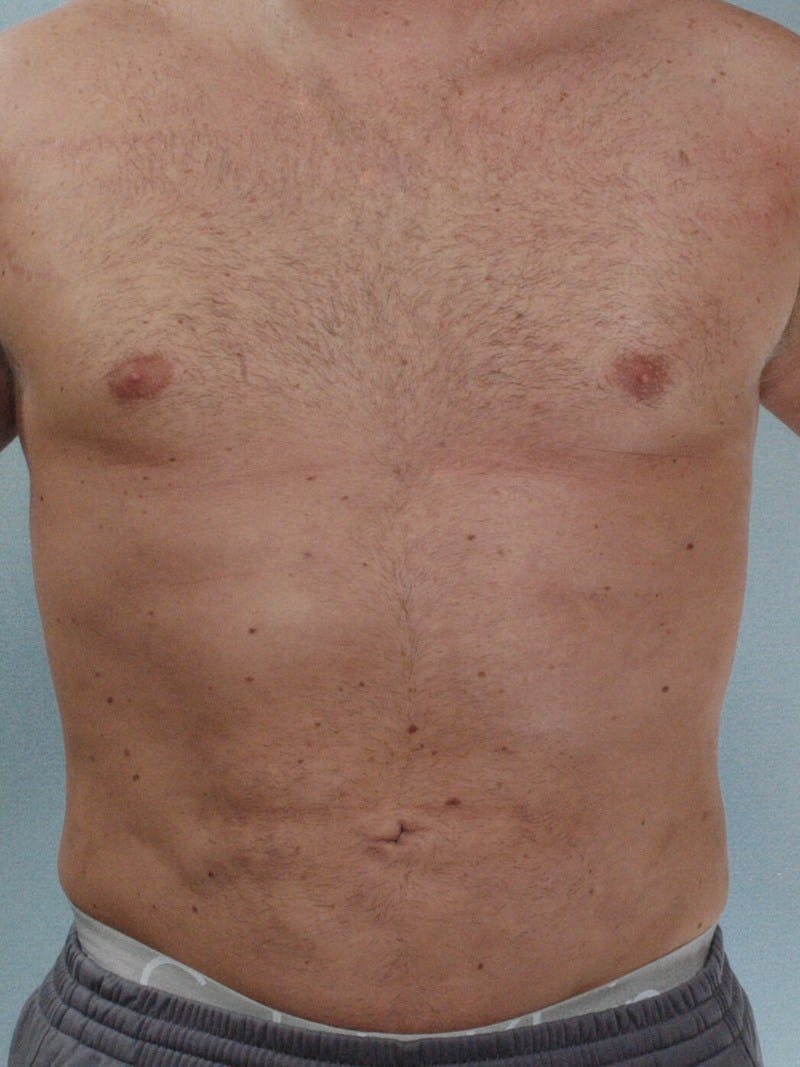 Abdominal Etching Before & After Gallery - Patient 191950 - Image 2