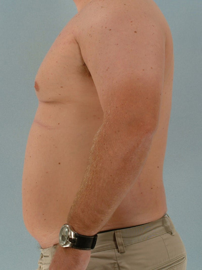 Abdominal Etching Before & After Gallery - Patient 191950 - Image 5