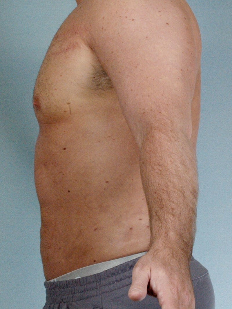Abdominal Etching Before & After Gallery - Patient 191950 - Image 6