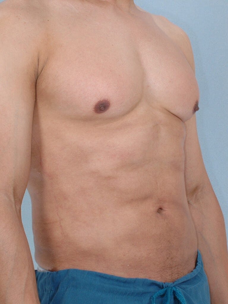 Abdominal Etching Before & After Gallery - Patient 213320 - Image 4