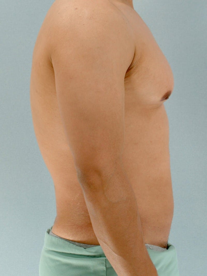 Abdominal Etching Before & After Gallery - Patient 213320 - Image 5