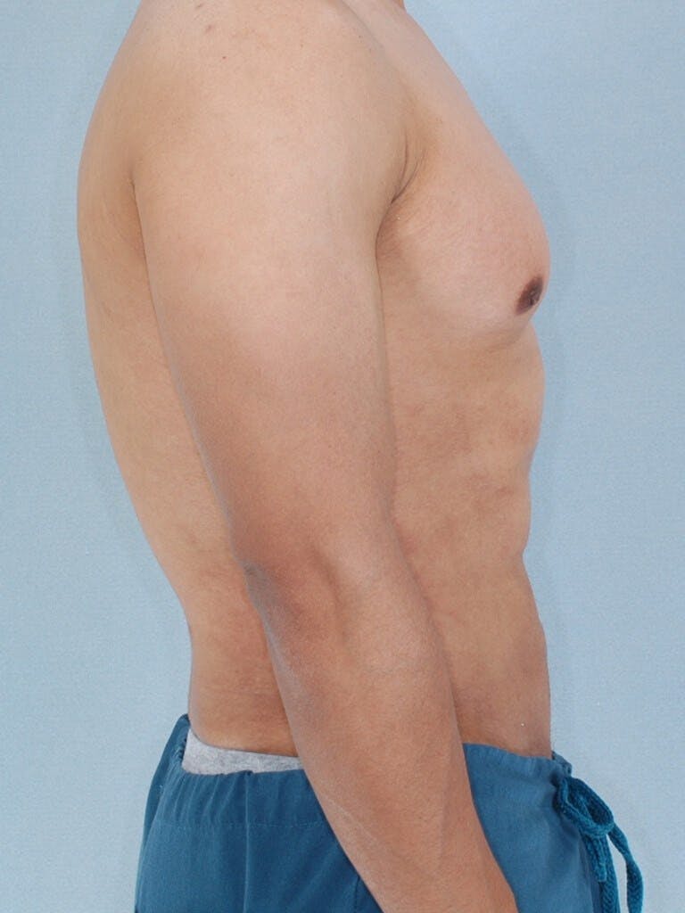 Abdominal Etching Before & After Gallery - Patient 213320 - Image 6