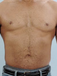 Abdominal Etching Before & After Gallery - Patient 232983 - Image 1