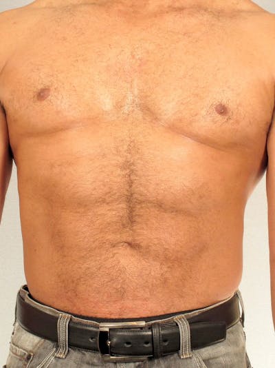 Abdominal Etching Before & After Gallery - Patient 232983 - Image 2