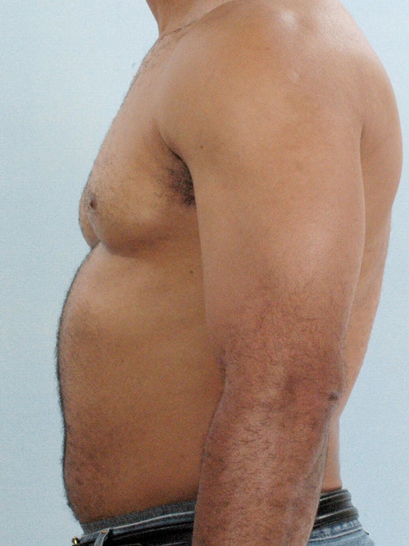 Abdominal Etching Before & After Gallery - Patient 232983 - Image 5